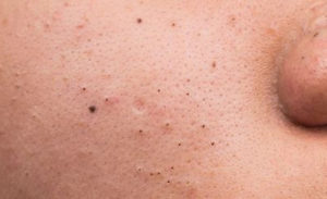 A closeup shot of blackheads. 