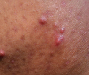 A closeup shot of cystic acne. 