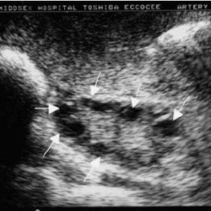 Ultrasound of ovaries that have small cysts on them. 