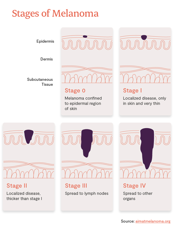 Different stages of melanoma
