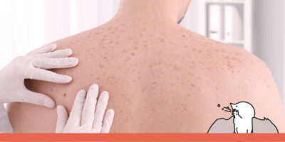 Skin cancer: types, causes, treatment, and prevention