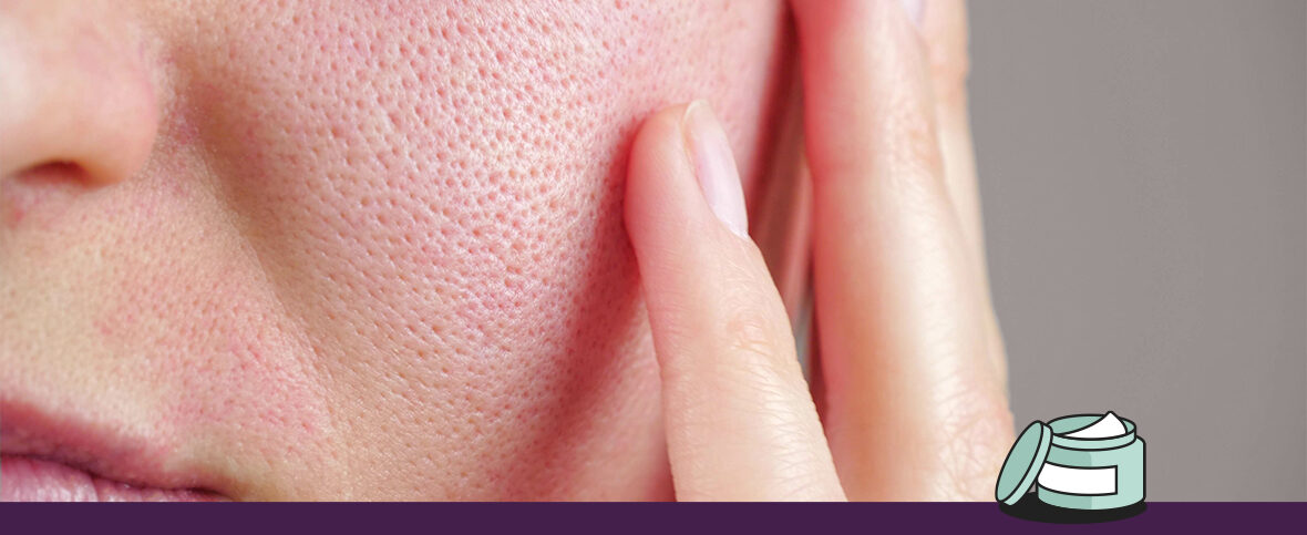Close-up of a person with rosacea skin touching their face. An illustrated jar of skin cream is below.